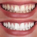 Creekside-Before-and-After-Zoom-Teeth-Whitening